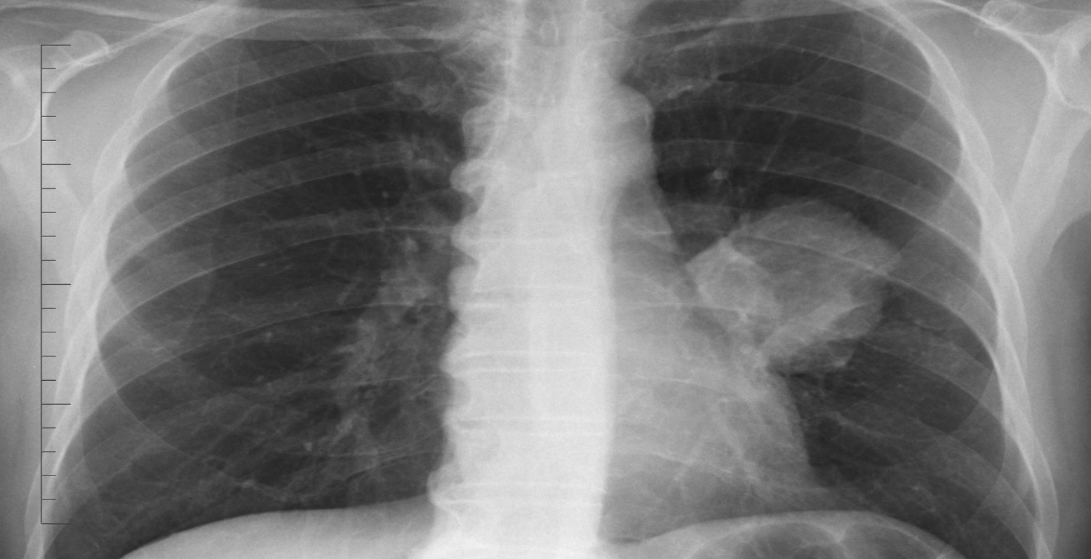 Туберкулома туберкулез рентген